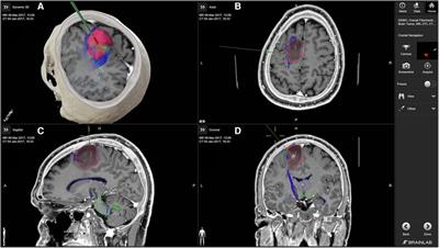 Neuronavigation in glioma resection: current applications, challenges, and clinical outcomes